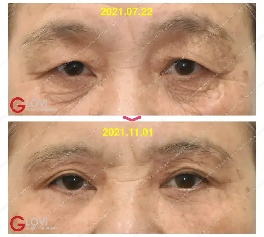 facial rejuvenation