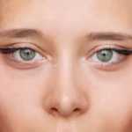 Side Effects of Blepharoplasty 