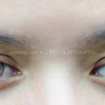 A Complete Guide to Ptosis Surgery: Treating Droopy Eyelids