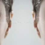 Lower Blepharoplasty: A Solution for Bags Under Eyes