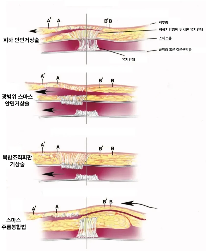 안면거상 수술 방법