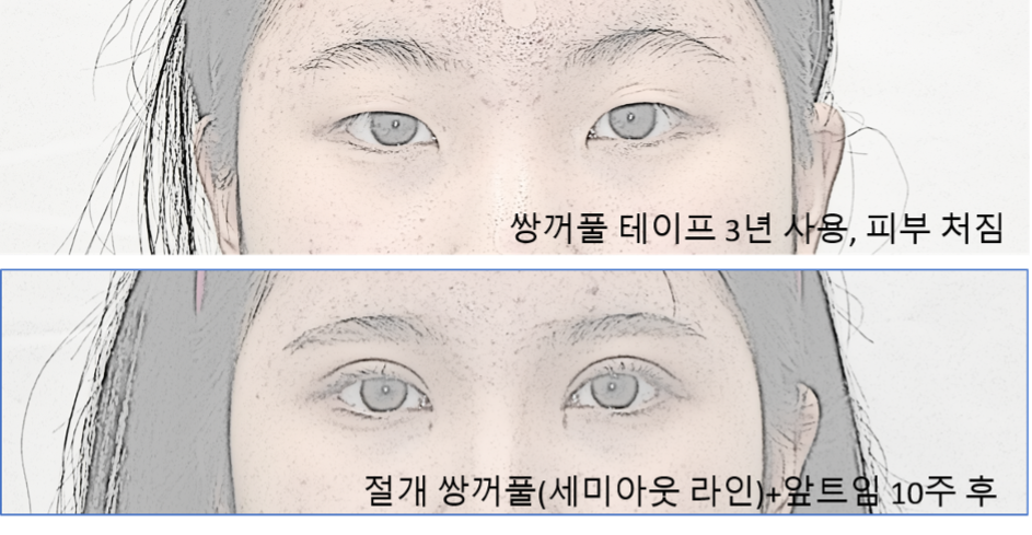 二重整形