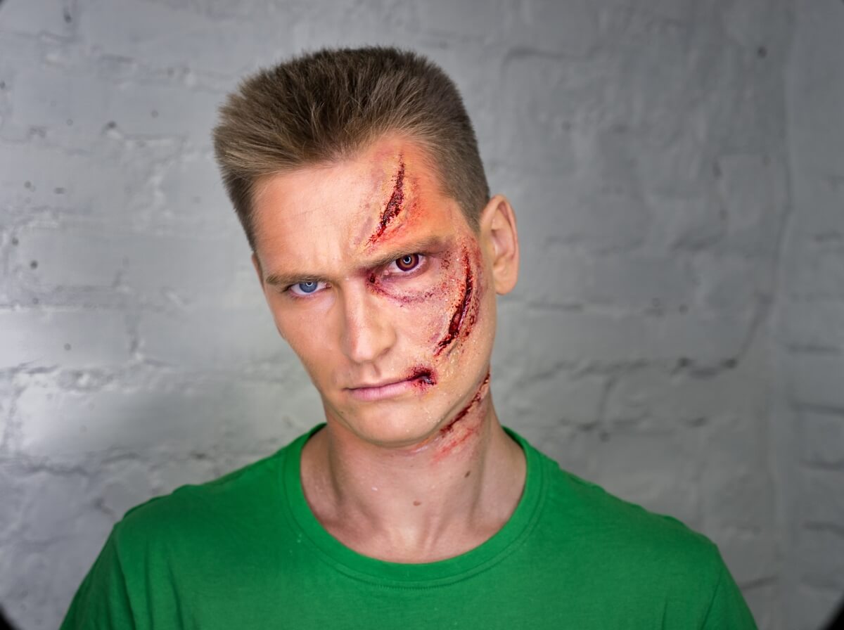 facelift scar