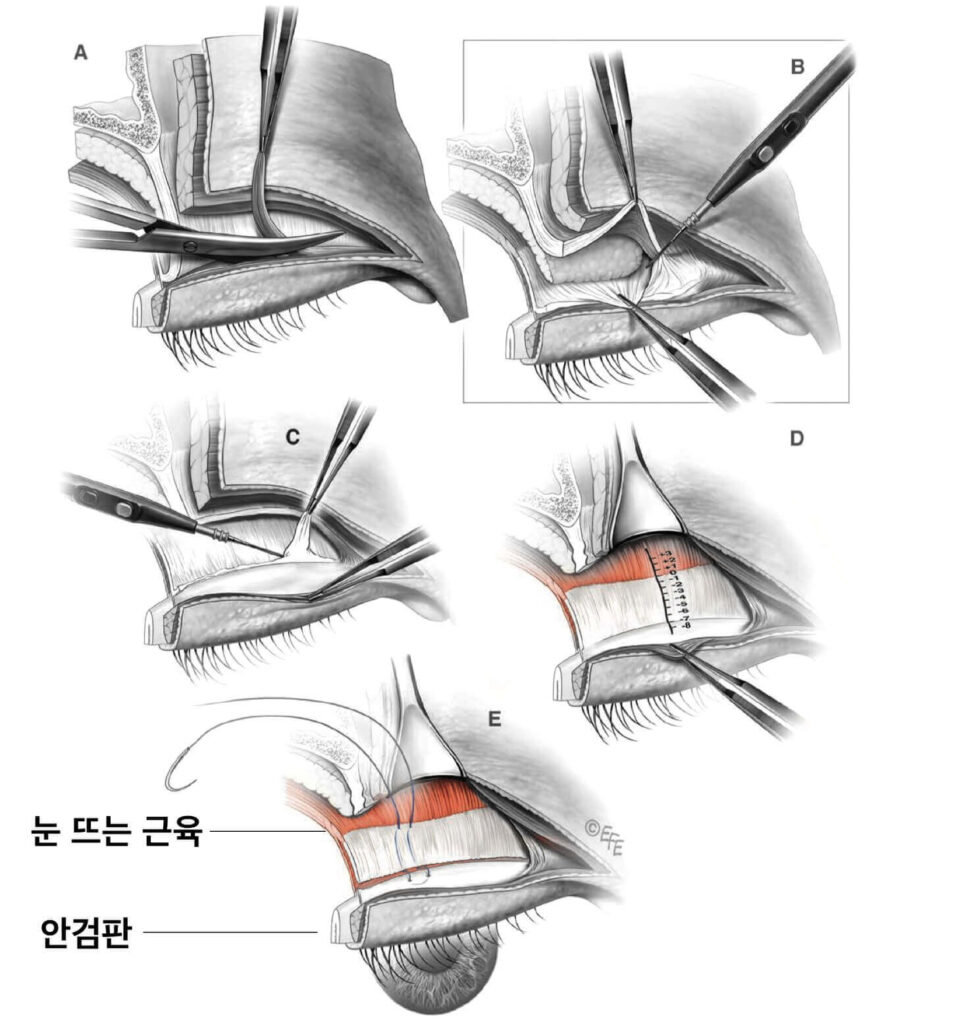 안검하수교정