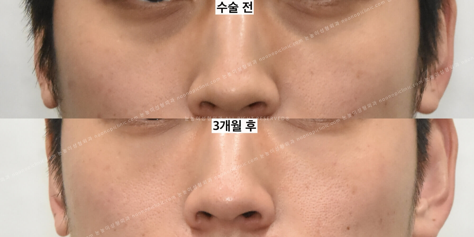 다크서클 치료