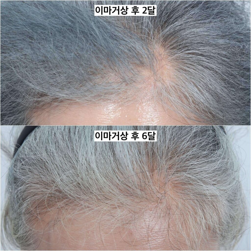brow-lift-hair-loss