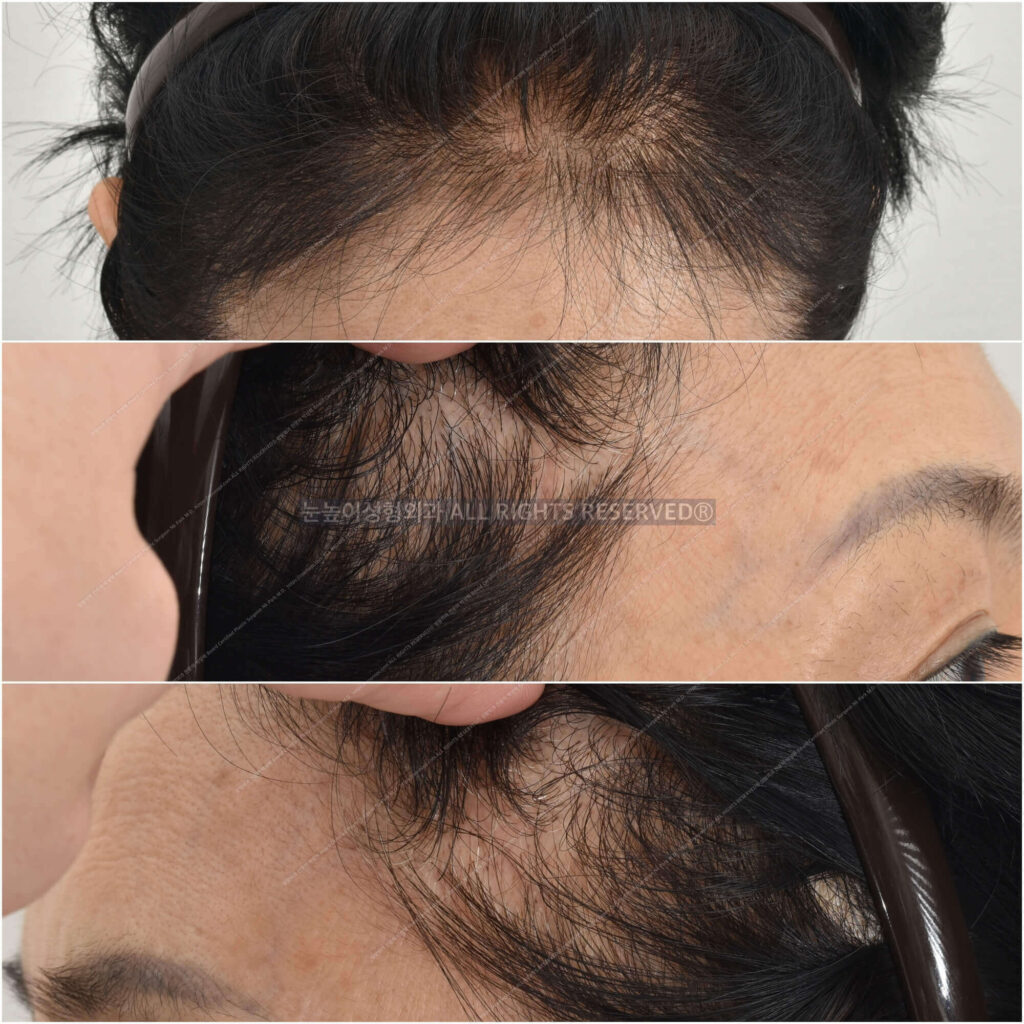 forehead-lift-scar