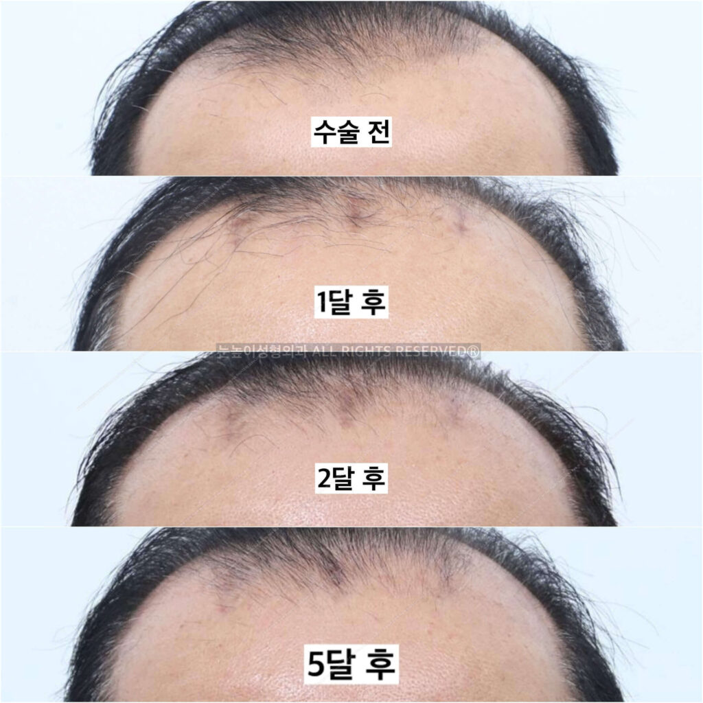 bald-brow-lift