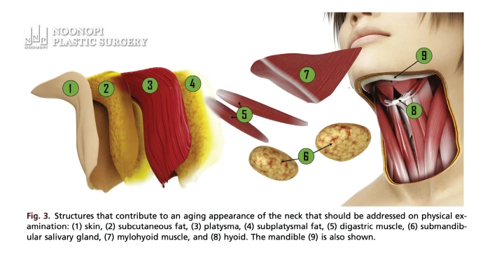 Why neck liposuction fails - Anatomy of platysma and deep fat