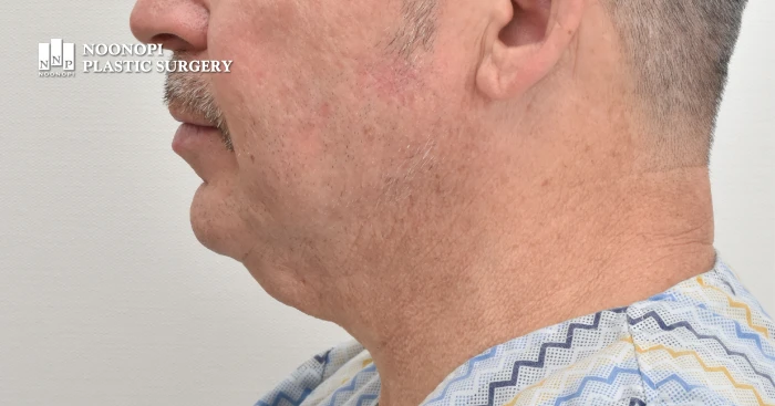 50s male mini neck lifting pre-op side profile