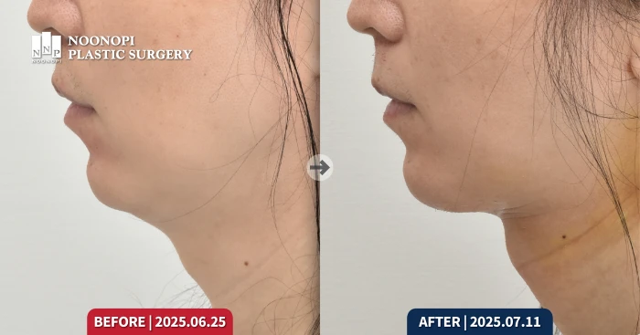 Correction of retruded chin and neck wrinkles