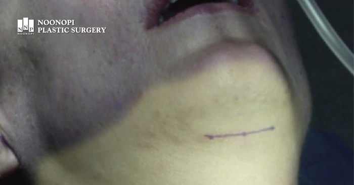 Platysmaplasty incision location for double chin surgery