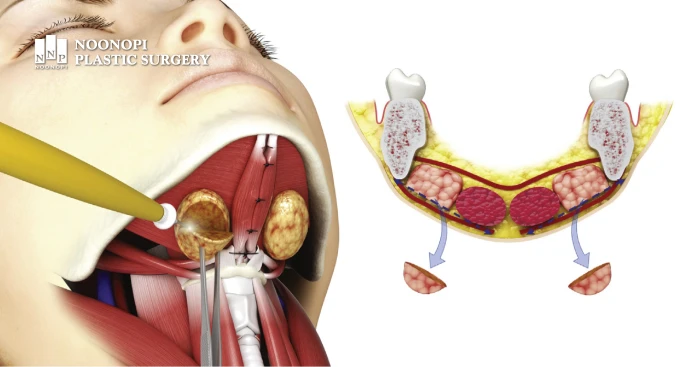 Submandibular gland removal illustration