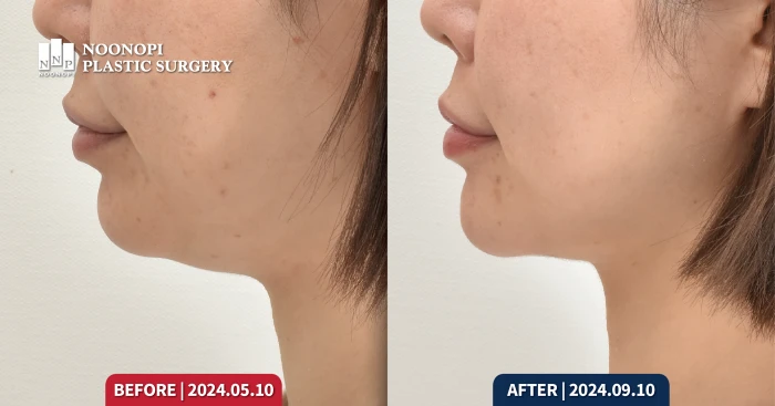 Mini neck lift result after 4 months