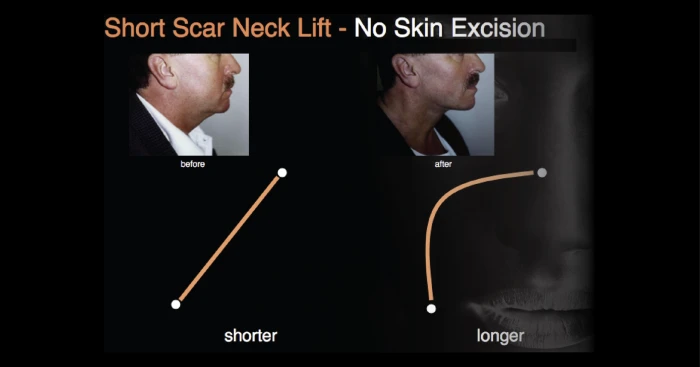 Why jawline becomes sharp without skin excision in mini neck lift