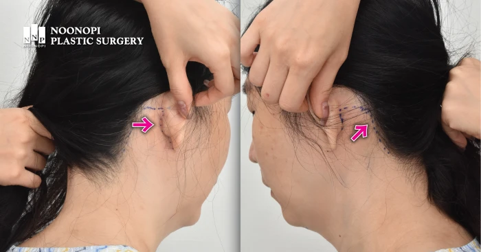 Full neck lift incision location