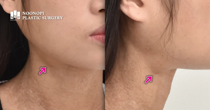 Submandibular gland hypertrophy case