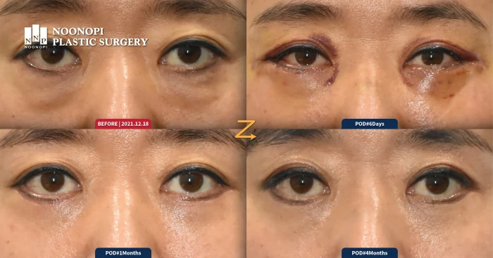 patient photo of lower blepharoplasty recovery timeline