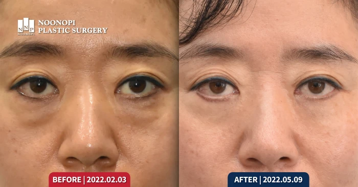 Korea lower eye surgery before and after 4 year result, woman healed lower blepharoplasty