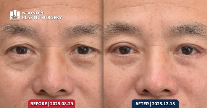 중년 남성의 상안검과 하안검 후 모습