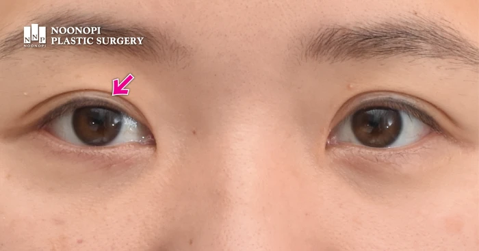 우측 눈 내측이 살짝 졸려보이는 미세한 짝눈, 수술 전 모습