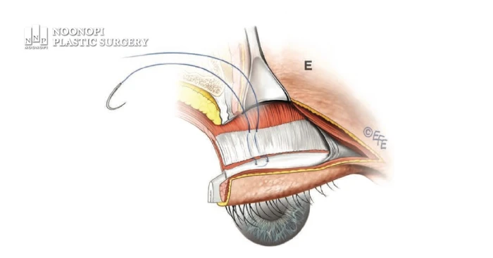 눈매교정은 근육이 더 강한 힘을 작용하게 만들어주는 수술