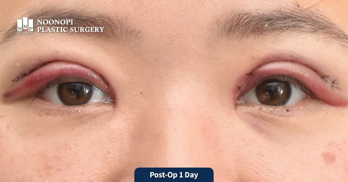 짝눈 교정을 위해 눈매교정한지 1일 후 모습