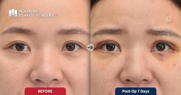 수술 7일 후에도 잔존하는 우측 미세 안검하수와 짝눈 증상