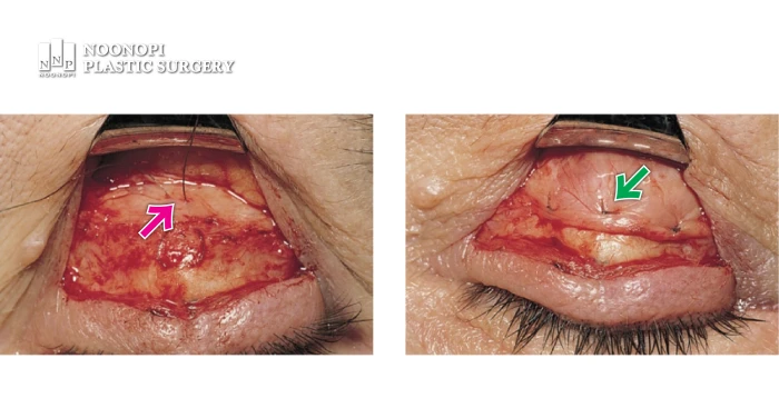 눈매교정은 느슨해진 근육을 안검판에 걸어주는 수술로, 근육을 많이 당길 수록 검은자위 노출이 더 증가된다