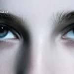 눈매교정 재수술, 환자를 다시 수술대에 눕힌 이유 (짝눈 후기 1)