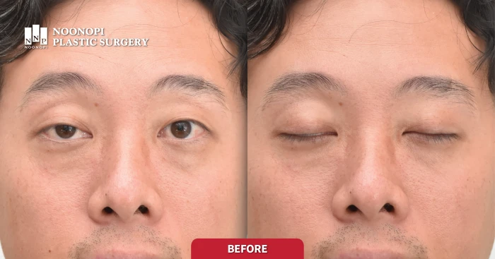 Asymmetric eyes caused by ptosis - Using forehead muscles to open eyes
