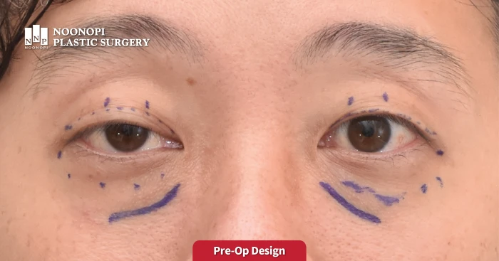 Plastic surgery Korea - Male ptosis correction design
