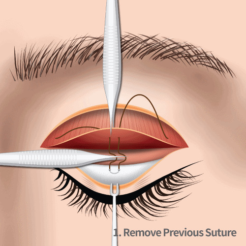 ptosis revision surgery step