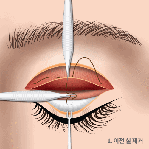 눈높이성형외과의 정교한 짝눈 교정 방법