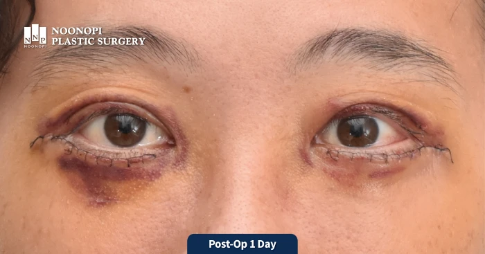 1 day after asymmetric eyes correction and lower blepharoplasty