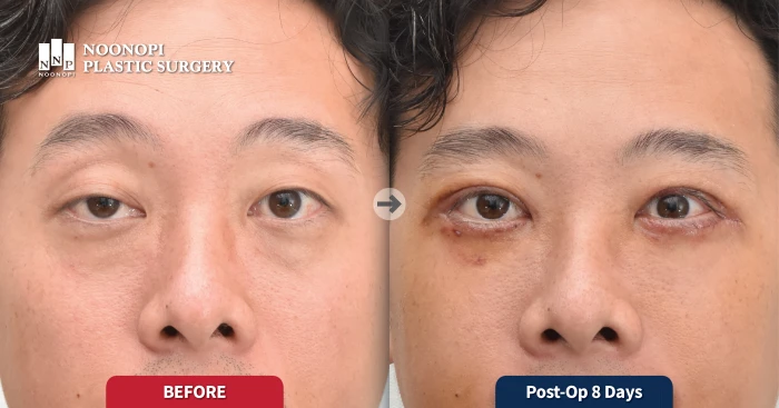 Male ptosis correction before and after 8 days - Sleepy eyes fixed