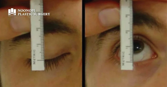 상안검거근(눈을 뜨는 근육)의 기능 검사를 하는 모습