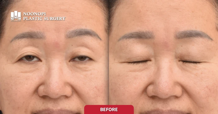 60s female with severe droopy eyelids and sleepy eyes