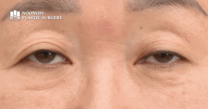 졸린 눈과 심한 안검하수로 시야가 가려진 60대 환자