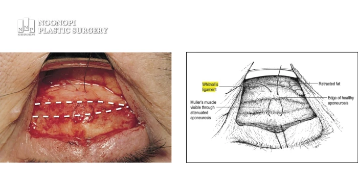 Diagram showing disinsertion of levator aponeurosis causing droopy eyelids