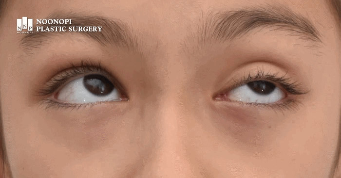 태어날 때부터 짝눈인 선천성 안검하수 환자, 졸린 눈 증상