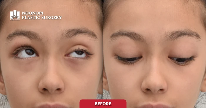 선천성 안검하수 수술 전 모습