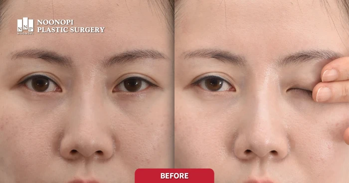 헤링의 법칙이란 졸린 눈을 가리면 졸립지 않는 눈까지 작아지는 현상을 일컫는다