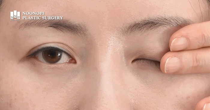 눈의 헤링현상을 설명하는 사진