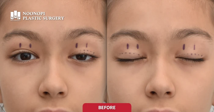 선천성안검하수 수술 디자인 모습