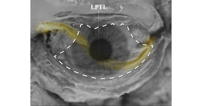 눈 뜨는 근육의 운동을 제한하는 Lower-Positioned Transverse Ligament