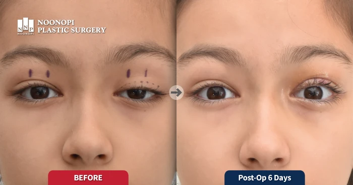 선천성 안검하수 눈매교정 6일 후 모습