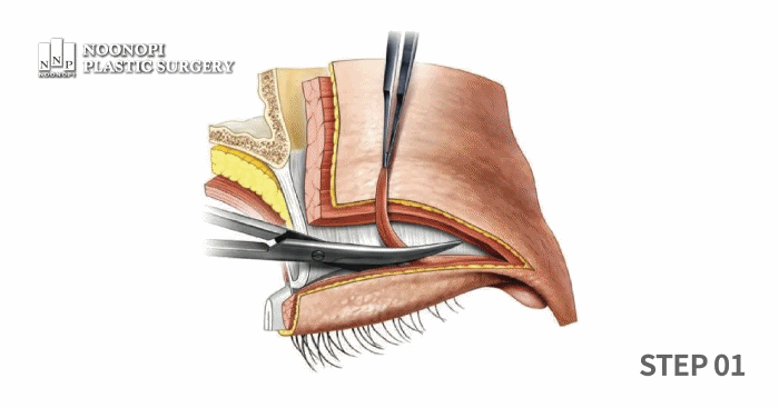 눈매교정의 단계