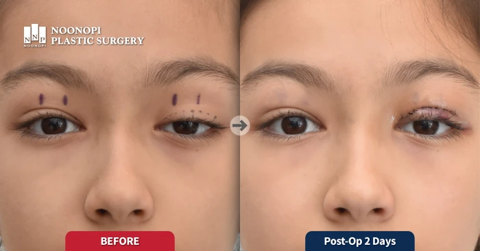 선천성 안검하수 눈매교정 전후, 소아 짝눈 개선 사례