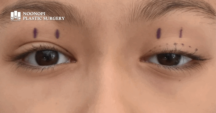 안검하수 수술 전 디자인 모습